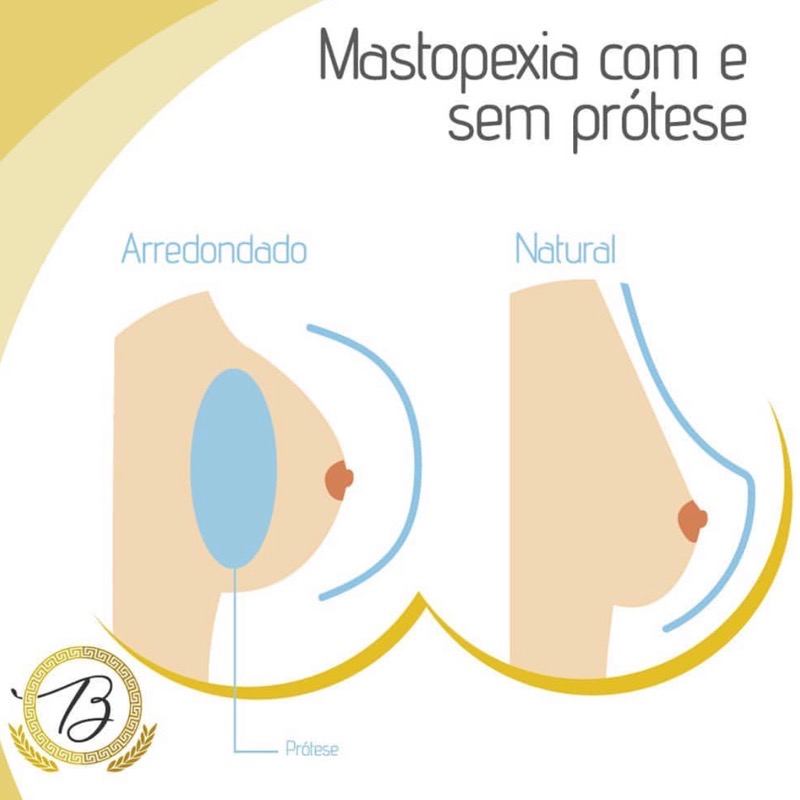 Mastopexia com ou sem prótese de silicone?